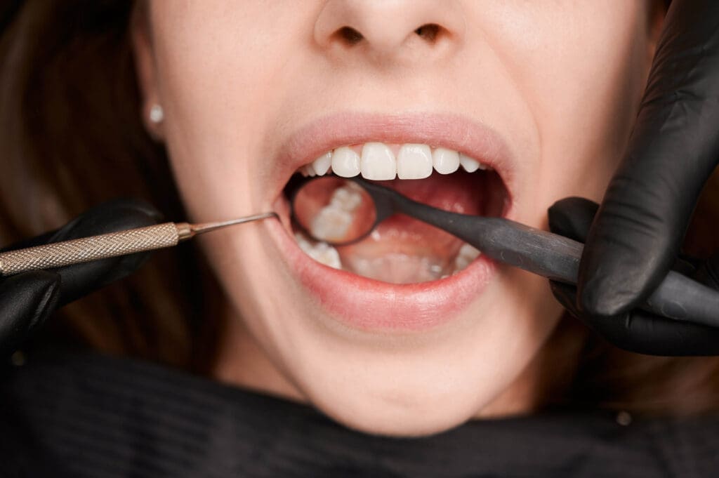 Okemos Dentist Close-up of a personโs open mouth during a dental examination, with a dentistโs gloved hands holding dental tools and inspecting the teeth.